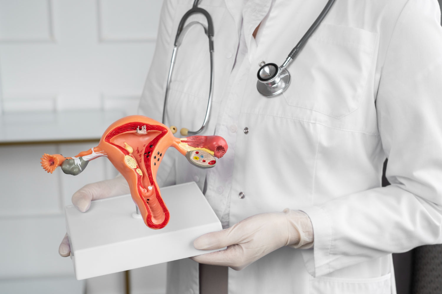 Cambio de nombre del Síndrome de Ovario Poliquístico a PMOS y su impacto en la salud hormonal femenina